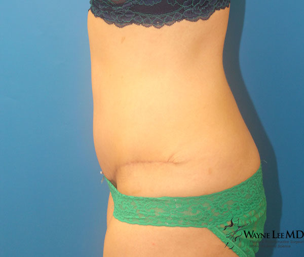 Tummy Tuck