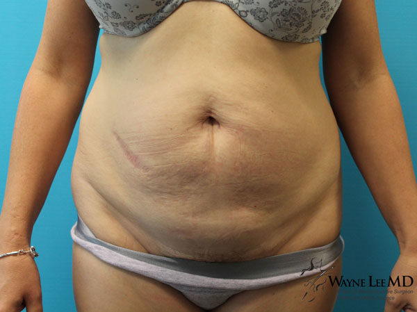 Tummy Tuck