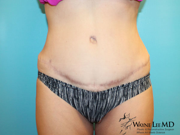 Tummy Tuck