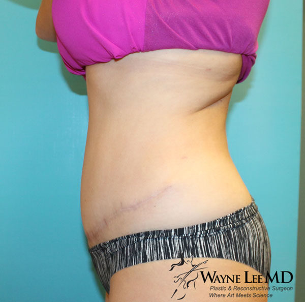 Tummy Tuck