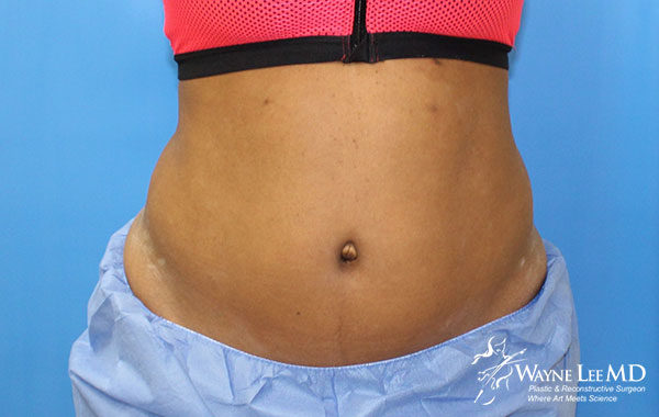 CoolSculpting