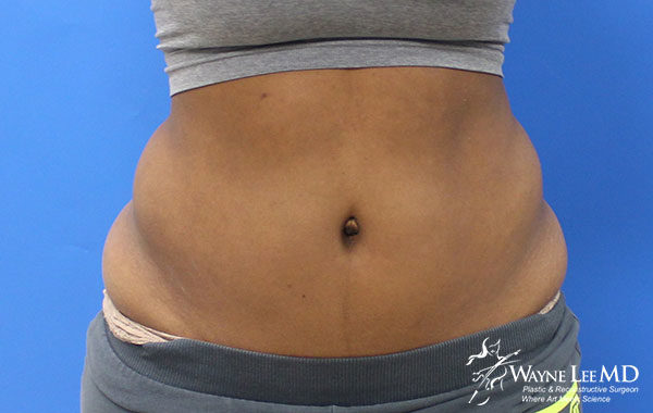 CoolSculpting