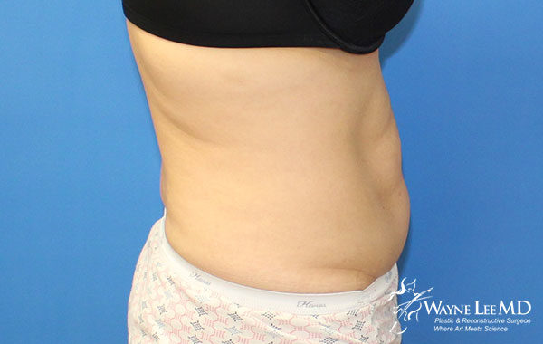 CoolSculpting