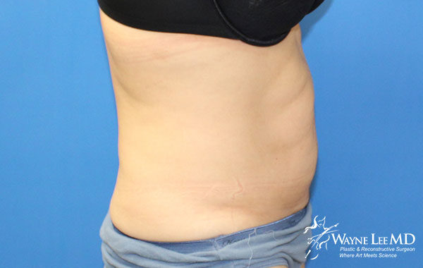 CoolSculpting