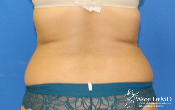 Cynosure-SmartLipo