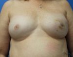 Breast Reconstruction