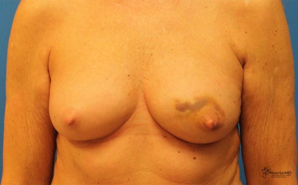 Breast Reconstruction