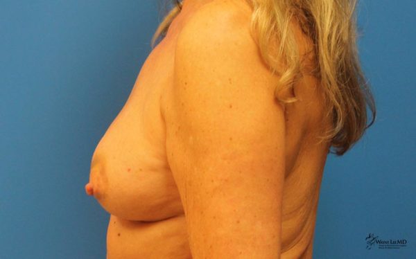 Breast Reconstruction