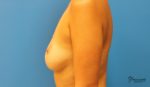 Breast Reconstruction