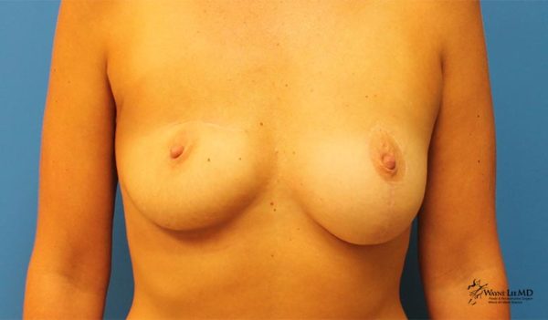 Breast Reconstruction