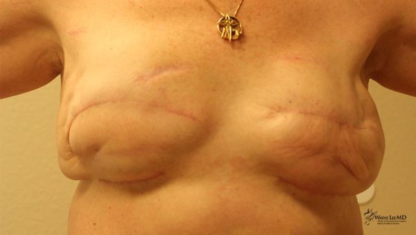 Breast Reconstruction