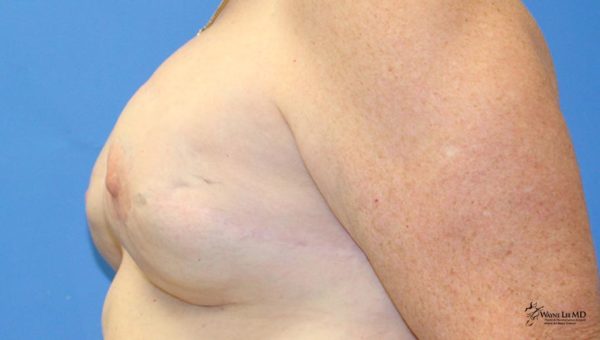 Breast Reconstruction