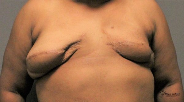 Breast Reconstruction