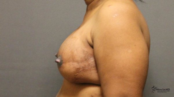 Breast Reconstruction