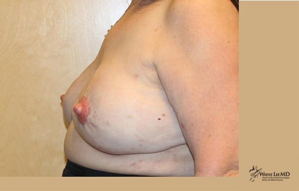 Breast Reconstruction