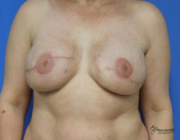 Breast Reconstruction