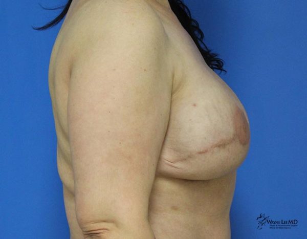 Breast Reconstruction