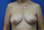 Breast Reconstruction