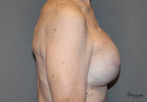 Breast Reconstruction