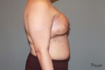 Breast Reconstruction