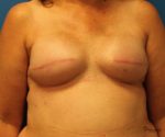 Breast Reconstruction