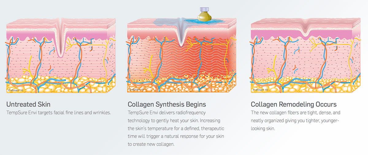 tempsure process