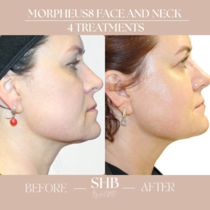Morpheus8 Before and After Treatment